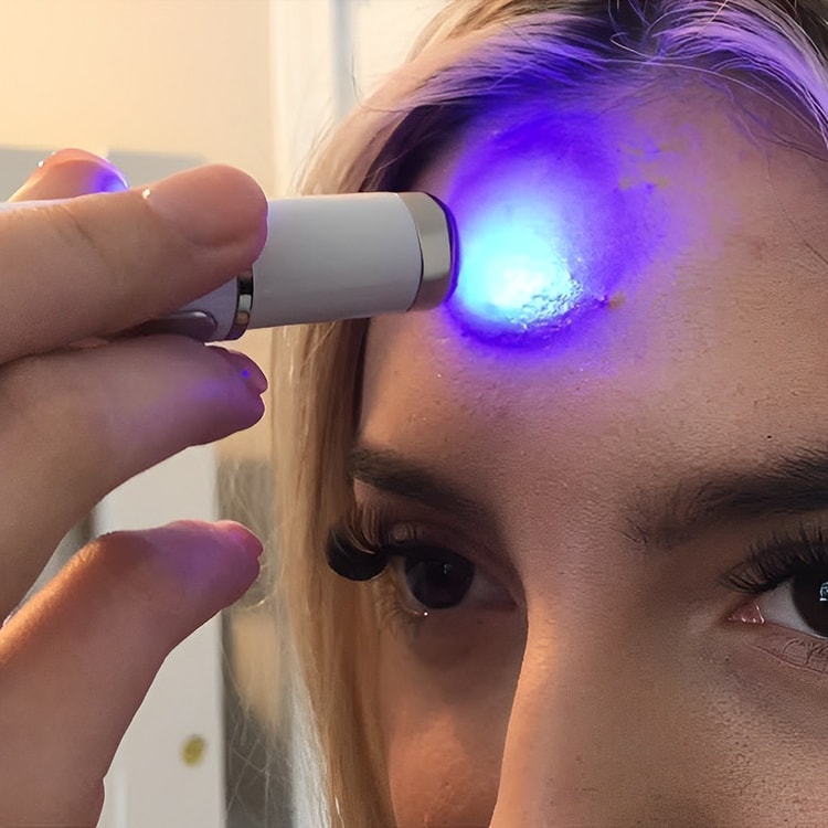 Innovative Anti-Fungal Laser Pen with Cutting-Edge Fungal Infections Removal and Safe-for-Skin Technology