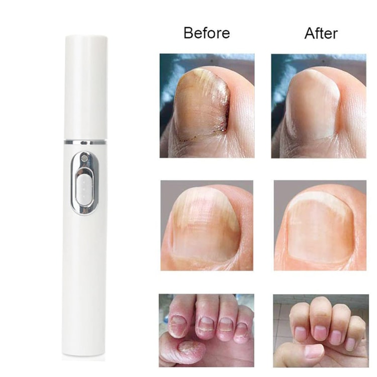 Innovative Anti-Fungal Laser Pen with Cutting-Edge Fungal Infections Removal and Safe-for-Skin Technology